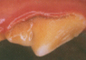 Stage 1 Gingivitis